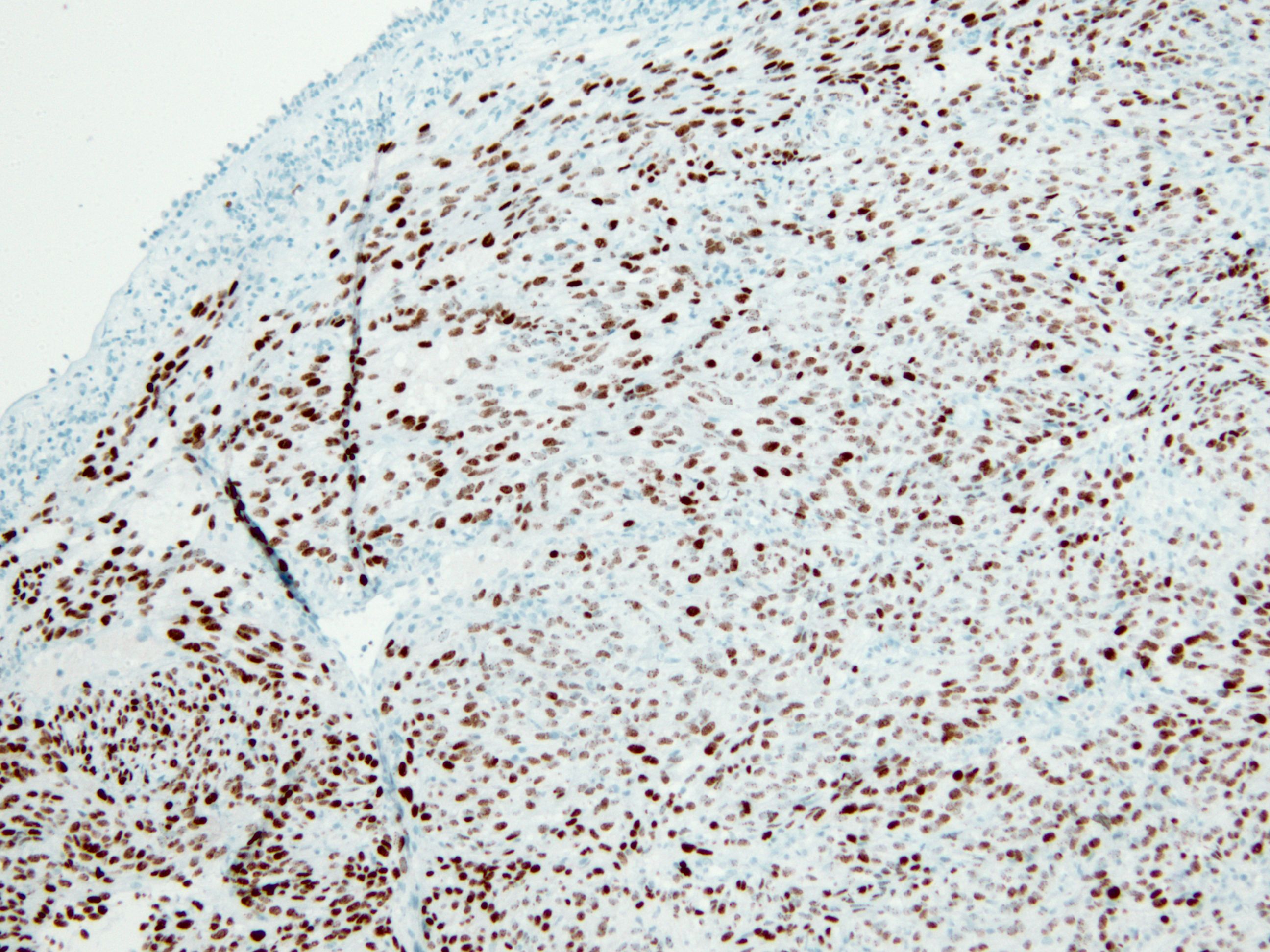 After STAT6, the immunostain I trust the most is HHV8 KiKo XP